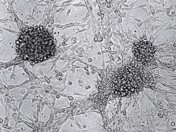 Traditional light-microscopy, such as this image of human brain-tumor cells in culture, still has a place in cancer research. 