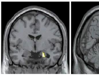 Brain images show the differences in activity patterns between the two groups of subjects that professor of psychology Jill Hooley examined. The brains of recovered depressed subjects (left) had more active amygdalae while listening to criticism than did the brains of subjects who had never been depressed. The brains of the latter showed more activation in the dorsolateral prefrontal cortex (center) and the anterior cingulate cortex (right) compared to brains of subjects with a history of depression.