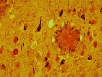 The look of Alzheimer's: tissue from the brain of a 69-year-old man, riddled with a large, dark protein plaque surrounded by damaged nerve fibers and by neurofibrillary tangles (the smaller dark blobs). Healthy aged adults exhibit these structures to a much lesser extent. 