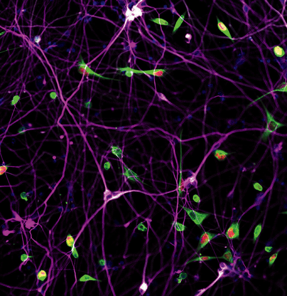 High resolution photograph of green cancer cells interacting with elongated purple neurons