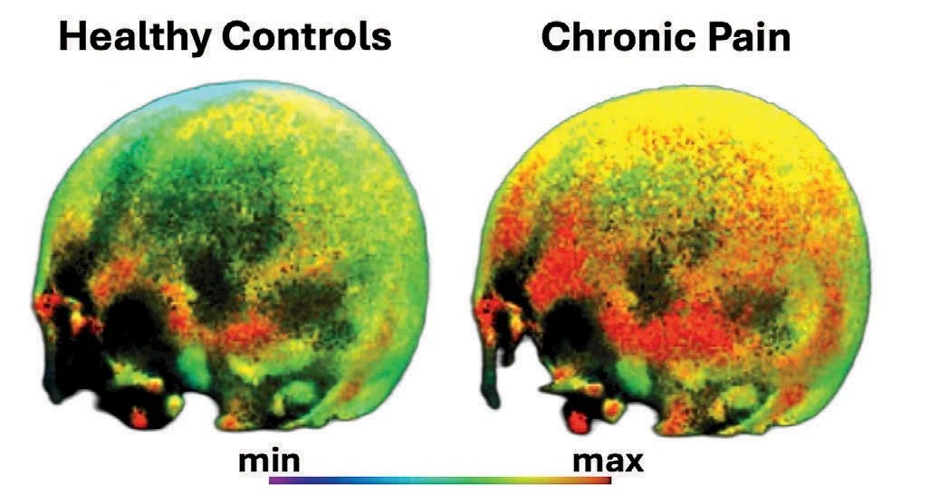 Diagram showing one brain colored mostly green labeled "Healthy Controls" and a brain on the right colored yellow and red labeled "Chronic Pain." A scale at the bottom depicts a range of colors from purple and blue on the "min" end, ranging to green, yellow and red on the "max" end