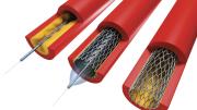 In angioplasty, a catheter sheathed by a deflated balloon is inserted (left) into an artery (red) clogged with plaque (yellow). When inflated (center), the balloon crushes the plaque into the walls of the artery and expands the wire mesh stent. The balloon is then deflated and removed, leaving the stent in place (right) to hold the artery open.  