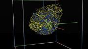 But to aid in the study and treatment of the disease, scientists and clinicians are turning increasingly to tools such as this three-dimensional brain-tumor simulation that shows the evolution of a population of cancer cells. (The colors indicate different clones of cancer cells.)