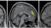 Brain images show the differences in activity patterns between the two groups of subjects that professor of psychology Jill Hooley examined. The brains of recovered depressed subjects (left) had more active amygdalae while listening to criticism than did the brains of subjects who had never been depressed. The brains of the latter showed more activation in the dorsolateral prefrontal cortex (center) and the anterior cingulate cortex (right) compared to brains of subjects with a history of depression.
