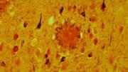 The look of Alzheimer's: tissue from the brain of a 69-year-old man, riddled with a large, dark protein plaque surrounded by damaged nerve fibers and by neurofibrillary tangles (the smaller dark blobs). Healthy aged adults exhibit these structures to a much lesser extent. 