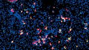 Viral delivery of a three-transcription-factor cocktail has transformed pancreatic exocrine cells (blue) into scattered insulin-producing beta cells (red). A preexisting islet, or grouping of beta cells, is outlined at the upper left.