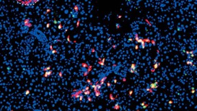 Viral delivery of a three-transcription-factor cocktail has transformed pancreatic exocrine cells (blue) into scattered insulin-producing beta cells (red). A preexisting islet, or grouping of beta cells, is outlined at the upper left.