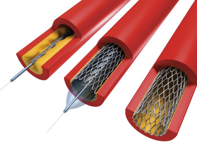 Image by ©Sciepro/Science Photo Library/Corbis In angioplasty, a catheter sheathed by a deflated balloon is inserted (left) into an artery (red) clogged with plaque (yellow). When inflated (center), the balloon crushes the plaque into the walls of the artery and expands the wire mesh stent. The balloon is then deflated and removed, leaving the stent in place (right) to hold the artery open.