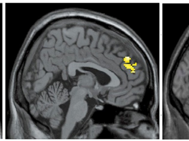 Images courtesy of <em>Psychiatry Research: Neuroimaging,</em> 171:2, page 14 (2009) Brain images show the differences in activity patterns between the two groups of subjects that professor of psychology Jill Hooley examined. The brains of recovered depressed subjects (left) had more active amygdalae while listening to criticism than did the brains of subjects who had never been depressed. The brains of the latter showed more activation in the dorsolateral prefrontal cortex (center) and the anterior cingulate cortex (right) compared to brains of subjects with a history of depression.