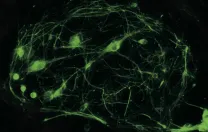 Motor neurons produced from reprogrammed cells enable researchers to study ALS in a petri dish.