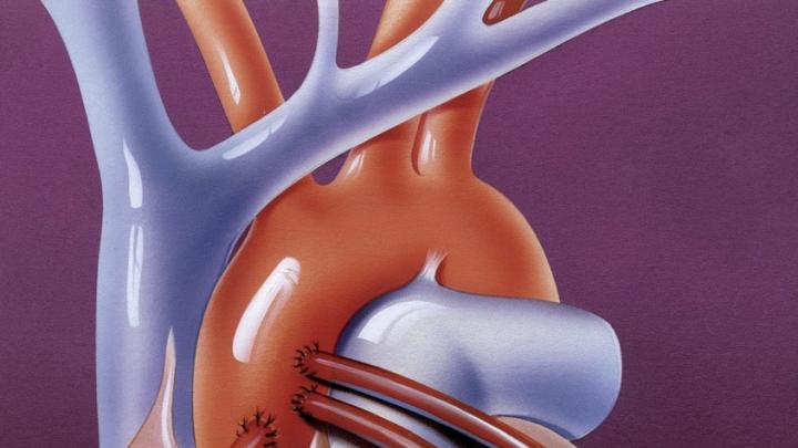 Three bypass arteries connect the aorta to smaller coronary arteries on the heart&rsquo;s outer surface. 