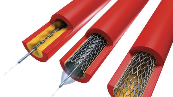 In angioplasty, a catheter sheathed by a deflated balloon is inserted (left) into an artery (red) clogged with plaque (yellow). When inflated (center), the balloon crushes the plaque into the walls of the artery and expands the wire mesh stent. The balloon is then deflated and removed, leaving the stent in place (right) to hold the artery open.  