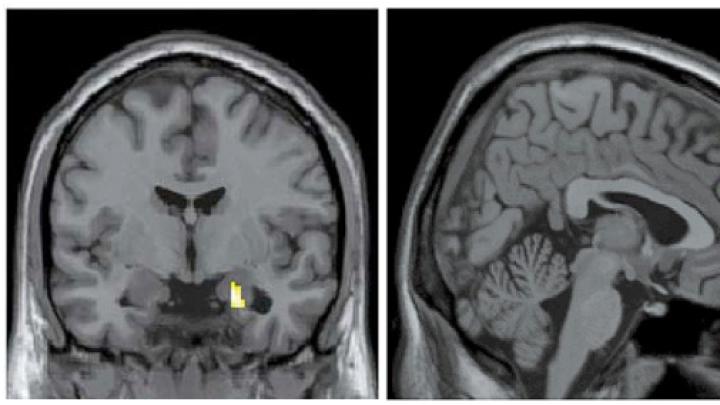 Brain images show the differences in activity patterns between the two groups of subjects that professor of psychology Jill Hooley examined. The brains of recovered depressed subjects (left) had more active amygdalae while listening to criticism than did the brains of subjects who had never been depressed. The brains of the latter showed more activation in the dorsolateral prefrontal cortex (center) and the anterior cingulate cortex (right) compared to brains of subjects with a history of depression.