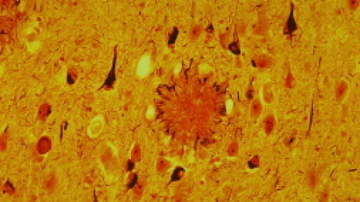 The look of Alzheimer's: tissue from the brain of a 69-year-old man, riddled with a large, dark protein plaque surrounded by damaged nerve fibers and by neurofibrillary tangles (the smaller dark blobs). Healthy aged adults exhibit these structures to a much lesser extent. 