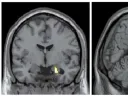 Brain images show the differences in activity patterns between the two groups of subjects that professor of psychology Jill Hooley examined. The brains of recovered depressed subjects (left) had more active amygdalae while listening to criticism than did the brains of subjects who had never been depressed. The brains of the latter showed more activation in the dorsolateral prefrontal cortex (center) and the anterior cingulate cortex (right) compared to brains of subjects with a history of depression.
